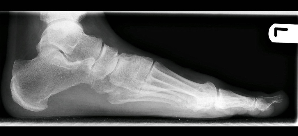 orthotics for flat foot problems
