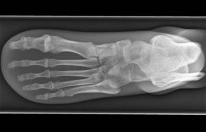 post-operative shoes in Arkansas