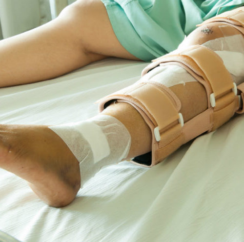 Need a cast fracture brace in Arkansas? Horton's can help.
