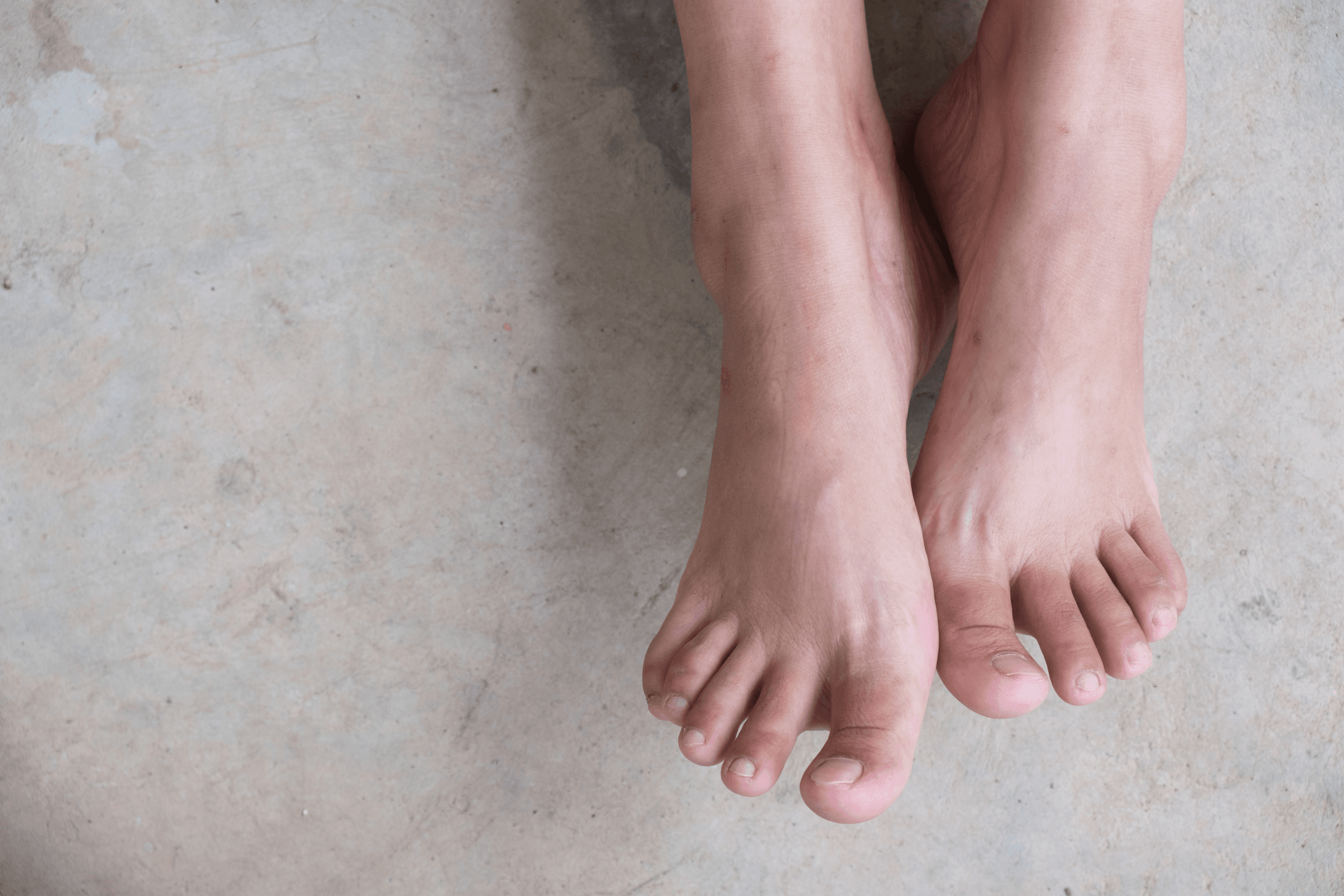 A pair of bare feet are against a white marble background. Learning how orthotics help flat feet can help you choose the best orthotics for you.