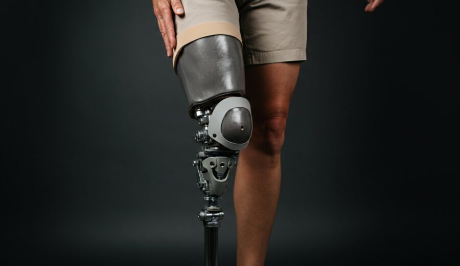 Woman from the waist down wearing tan shorts and a prosthetic leg, standing.