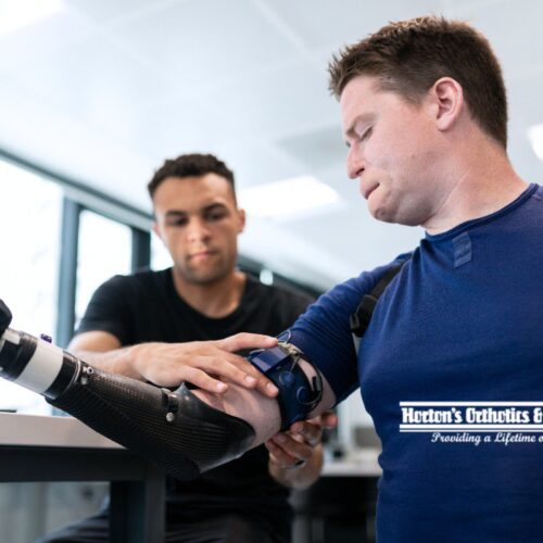 Prosthesis Fitting Process: What Should You Expect First? cover