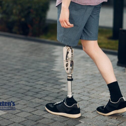 life after diabetes amputation