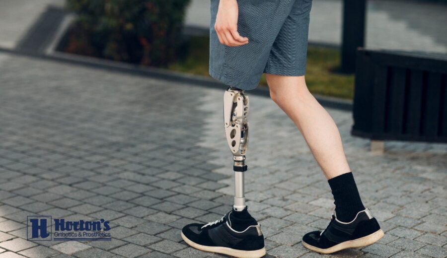 life after diabetes amputation